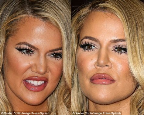 Khloe Kardashian Finally Admits Facial Fillers Really Wrecked Her Face Facial