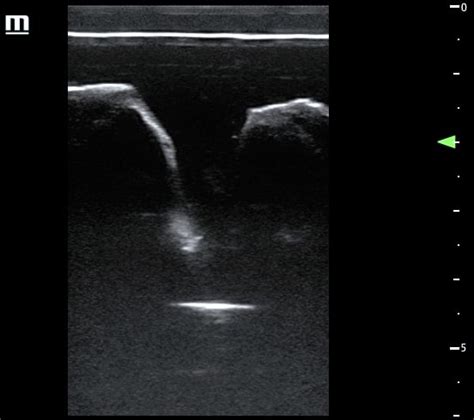 Diy Ultrasound Model Procedure Lumbar Puncture