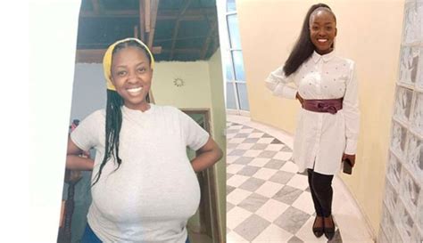My Struggle With Big Breasts 35kgs Were Taken Off My Chest