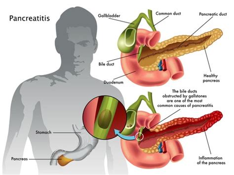 Pancreatitis Symptoms Complications And Treatment