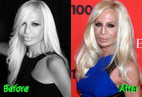 Donatella Versace Before And After Cosmetic Surgery Donatella Versace