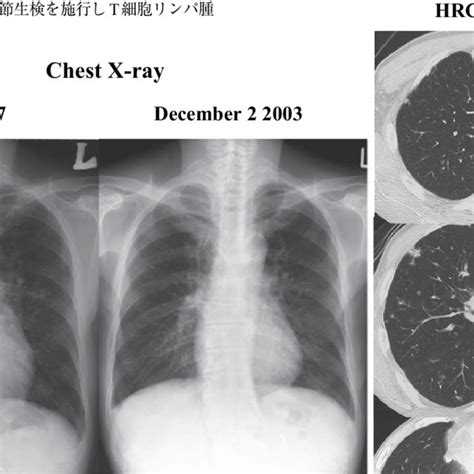 Pa Chest Radiograph And Ct Showed Mild Bilateral Hilar Lymph Node