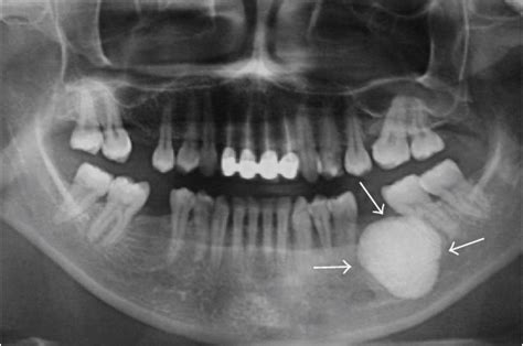 Figure 3 From Large Peripheral Osteoma Of The Mandible A Case Report