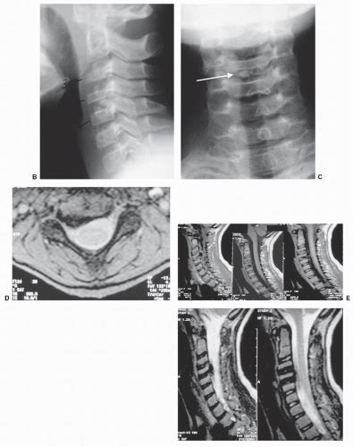 Cervical Spine Tumors And Infections In Children Neupsy Key