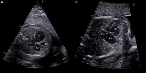 Frontiers Hypoplastic Left Heart Syndrome Is There A Role For Fetal