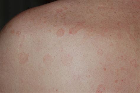 Pityriasis Rosea Pics Pictures Photos