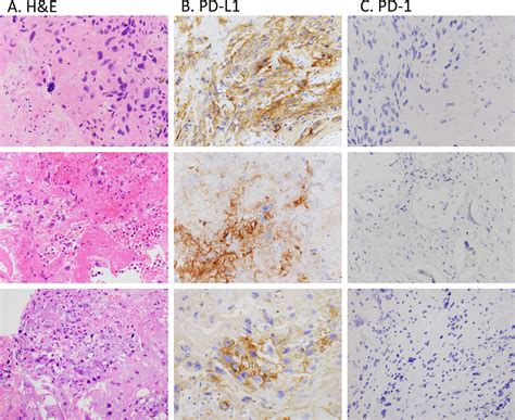 Pd L1 And Pd 1 Expression In Pediatric Central Nervous System Germ Cell