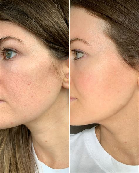 Retinol Before And After