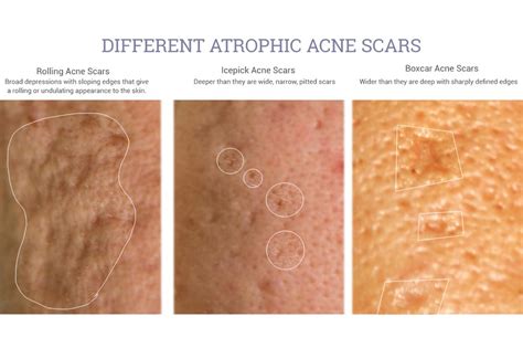 5 Acne Scar Laser Treatments In Singapore From S88 That Work—including