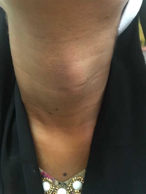 Anterior Neck Swelling