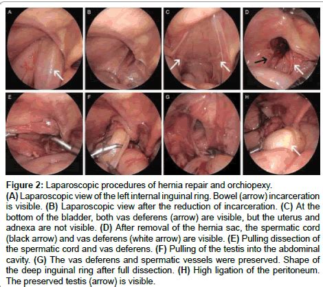 The term 46,xy refers to the chromosomes found in most cells of the fetus. clinical-case-reports-Laparoscopic-procedures