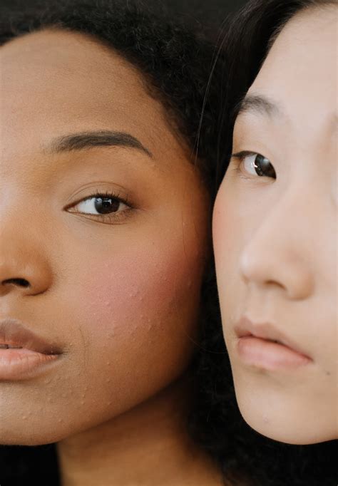 What Is Acne Cosmetica And How Can I Avoid It