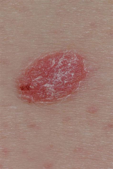 What Are The First Sign Of Skin Cancer Pictures Of Skin Cancer Skin