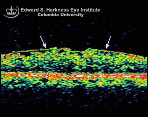 Epiretinal Membrane Vagelos College Of Physicians And Surgeons