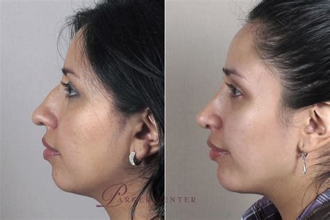 Cheekchin Implants Before And After Pictures Case 165 Paramus Nj