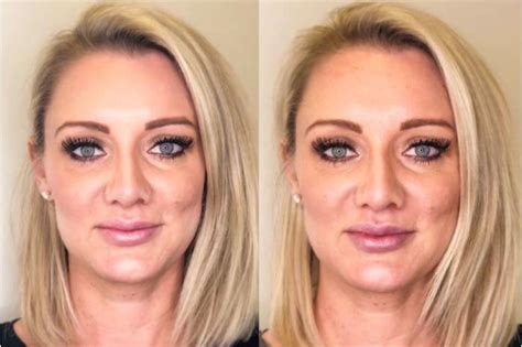 Dermal Fillers Before And After Pictures Case Chico Yuba City Oroville CA Hodari MD