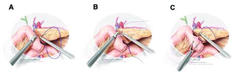 Illustration Of The 2 Types Of Pancreatojejunostomy Anastomoses A