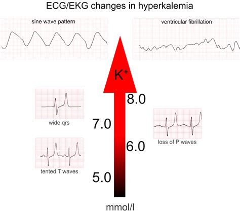Medicowesome Ecg Changes Seen In Hyperkalemia And Hypokalemia Mnemonic