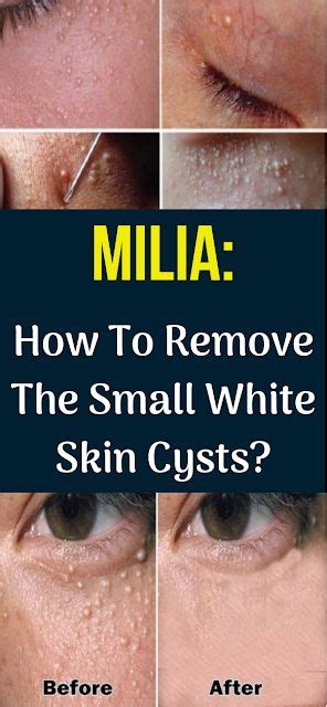 Milia How To Remove The Small White Skin Cysts Milia Homeremedies