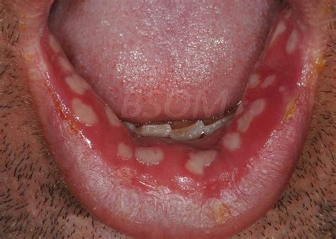 Sudden Onset Painful Mouth Ulcers Herpes British Irish Society