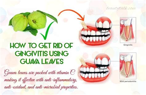 12 Ways On How To Get Rid Of Gingivitis Naturally And Quickly