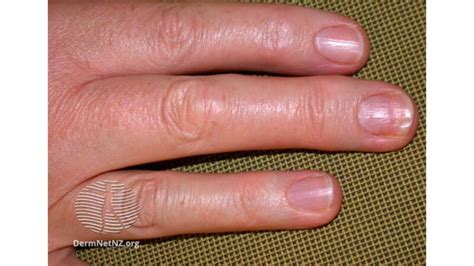 Dactylitis Sausage Fingers Causes And Treatments