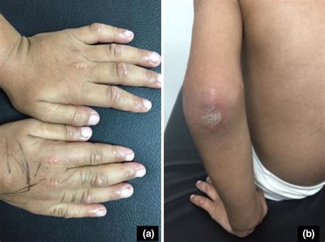 Erythema And Skin Colored To Erythematous Nodules Are Present On The