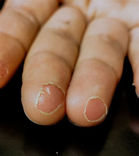 Fingertip Peeling Causes Remedies And Prevention