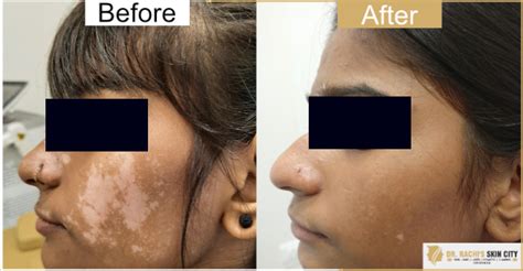 Dr Rachi S Skin City Vitiligo Treatment White Spot