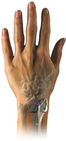 Wrist Fractures | Wright Medical Group