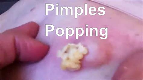 Pimples Popping 2017 Youtube