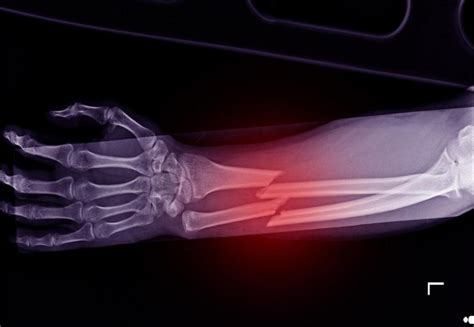 Paris Orthopedics How To Know If Your Bone Is Broken Broken Bones