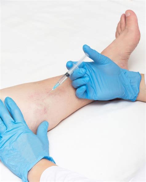 Vein Injection Sclerotherapy Meridian Cosmetic