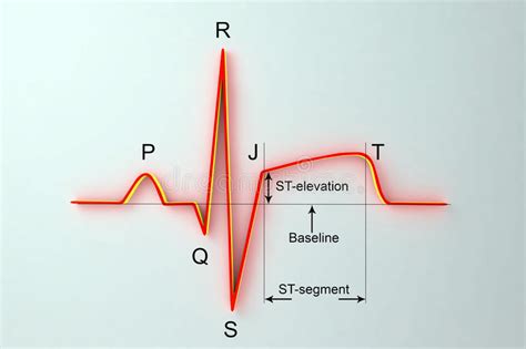 Journal of the american college of cardiology vol. ECG In Myocardial Infarction. Illustration Showing ST Elevation, Labeled Image Stock ...