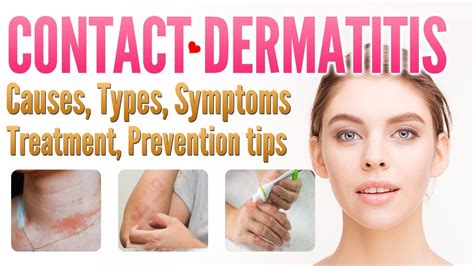 Contact Dermatitis Causes Types Symptoms Treatment Prevention