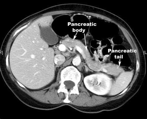 Computed tomography or computerized axial tomography (ct or cat) positron emission tomography &dash; Pancreatitis