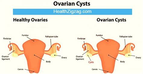 Treatment Of A Ruptured Ovarian Cyst Healthzigzag