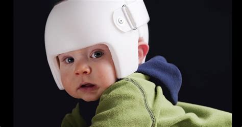 Do Baby Helmets Correct Skull Formation