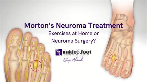 Mortons Neuroma Specialist In Nashville Tennessee