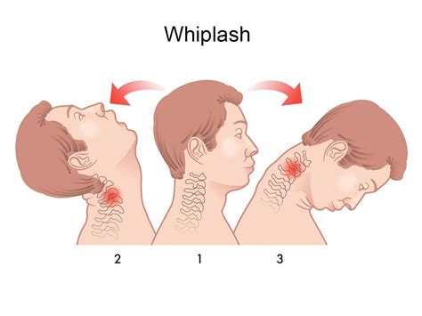 Whiplash Response Regimen Edmonton Whiplash Injury Clinic