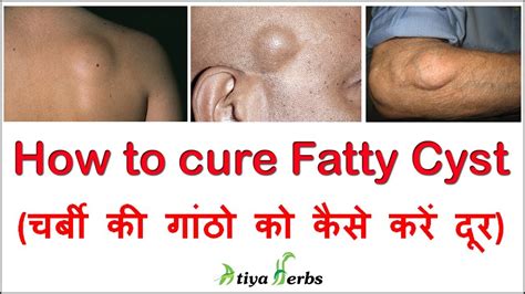 How To Cure Fatty Cyst Hakim Suleman Khan चर्बी की गांठो को कैसे