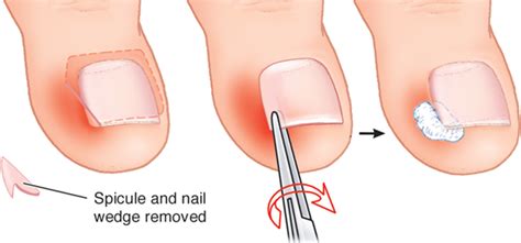 Then, your cat will probably be put on antibiotics to treat the infection. How To Get Rid Of An Ingrown Toenail? Natural Remedies