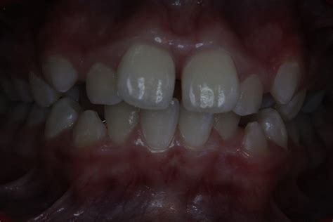 What Is A Tongue Thrust Habit Align Dentistry Blog Call 02 9723 5757