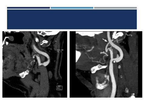 Ct Angiography Head And Neck