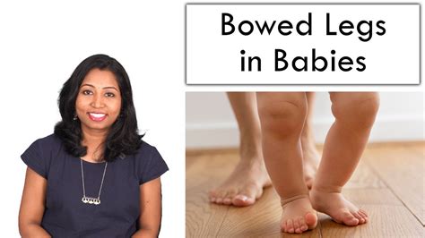 Bowed Legs In Babies Reason And Cure Youtube