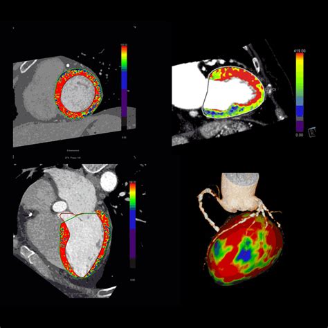 Ct Cardiovascular Imaging