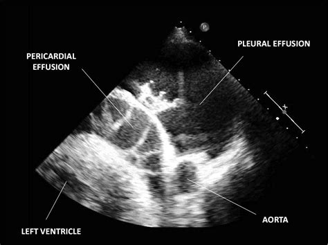 Pericardiocentesis From Back Under Echographic Guidance Circulation