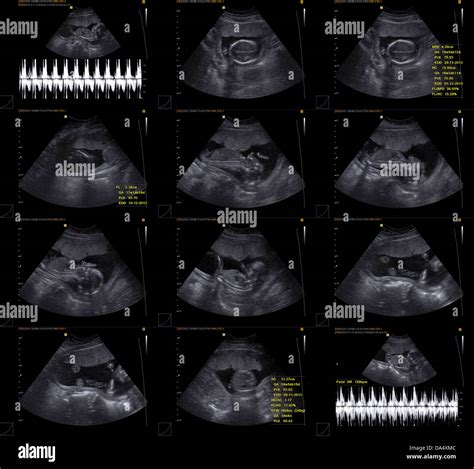 Normal Obstetrical Ultrasound Including Döppler Stock Photo Alamy