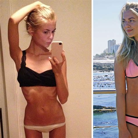 Skinny Anorexic Girls Pics Telegraph