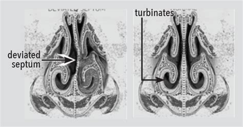 Turbinate Reduction Texas Sinus And Snoring